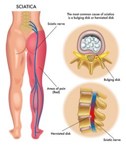 orlando pain clinic treats sciatica